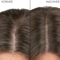 Anti-Schuppen Kopfhaut Serum 100 ml