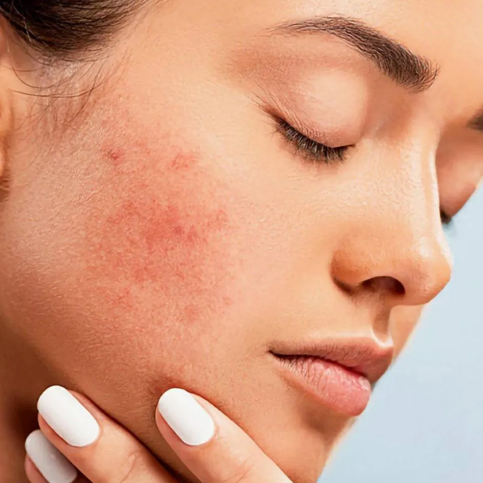 MED+ Anti-Red RR Cream Redness Reduction SPF 30 30 ml
