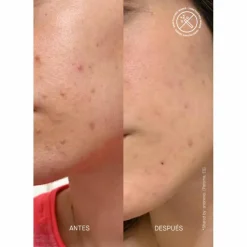 PIE Acne Red Spot Fading Treatment 30 ml
